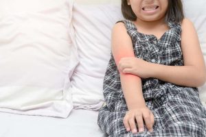 تأیید اپزلورا (Opzelura) توسط FDA برای درمان درماتیت آتوپیک در کودکان